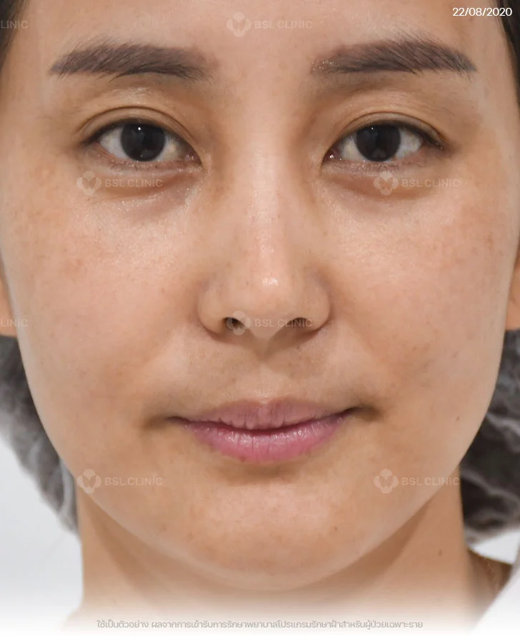 ผลการรักษาฝ้า-ฝ้าแดด-รักษาฝ้าที่บีเอสแอล-After