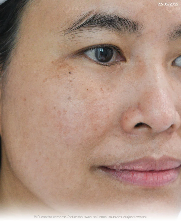 ผลการรักษาฝ้าฮอร์โมน-ฝ้าแดด-รักษาฝ้าที่บีเอสแอล-After