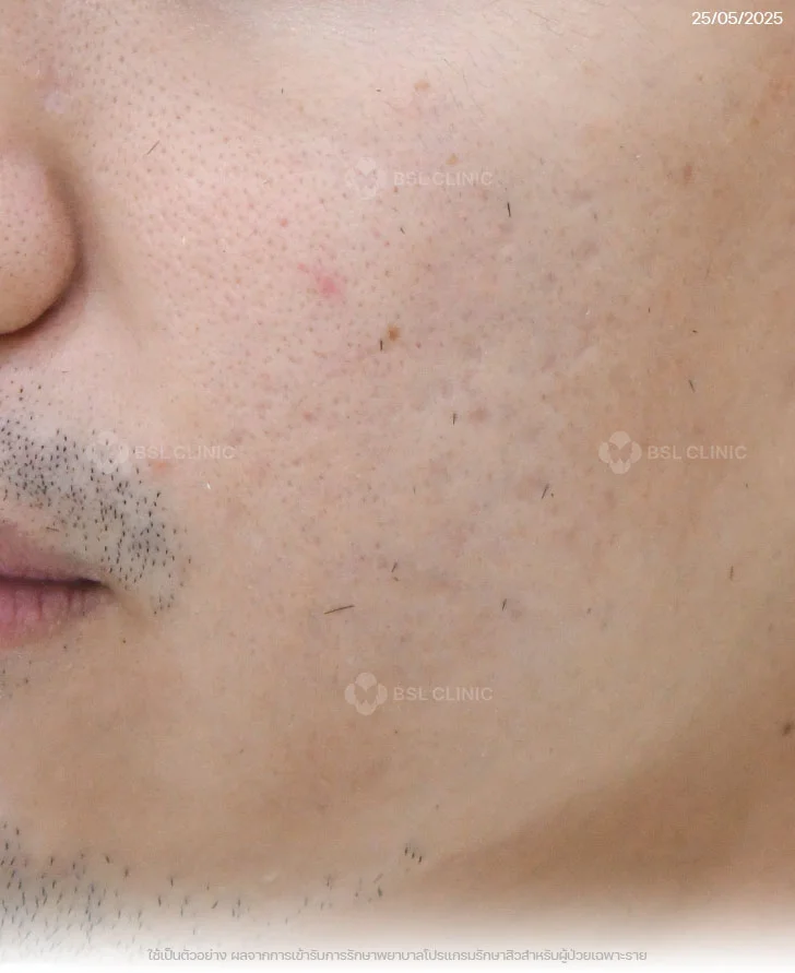 ผลการรักษาสิว-สิวอุดตัน-สิวอักเสบ-รอยแดงสิว-After (1)