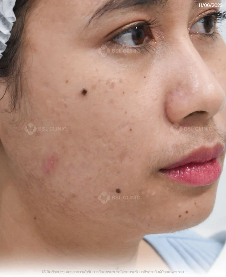 ผลการรักษาสิว-สิวอุดตัน-สิวอักเสบ-รอยแดงสิว-After-หลังรักษา