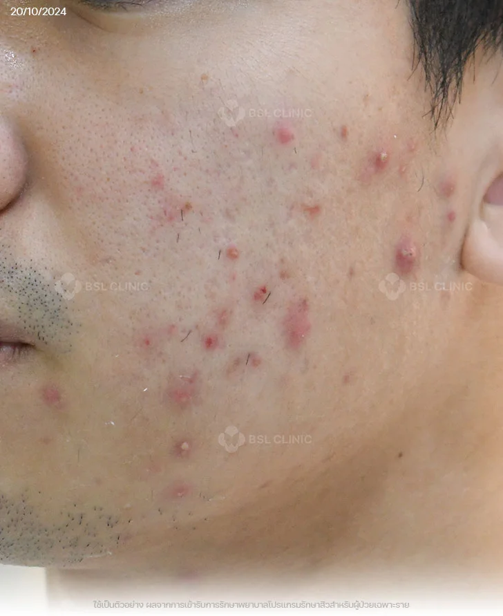 ผลการรักษาสิว-สิวอุดตัน-สิวอักเสบ-รอยแดงสิว-Before (1)