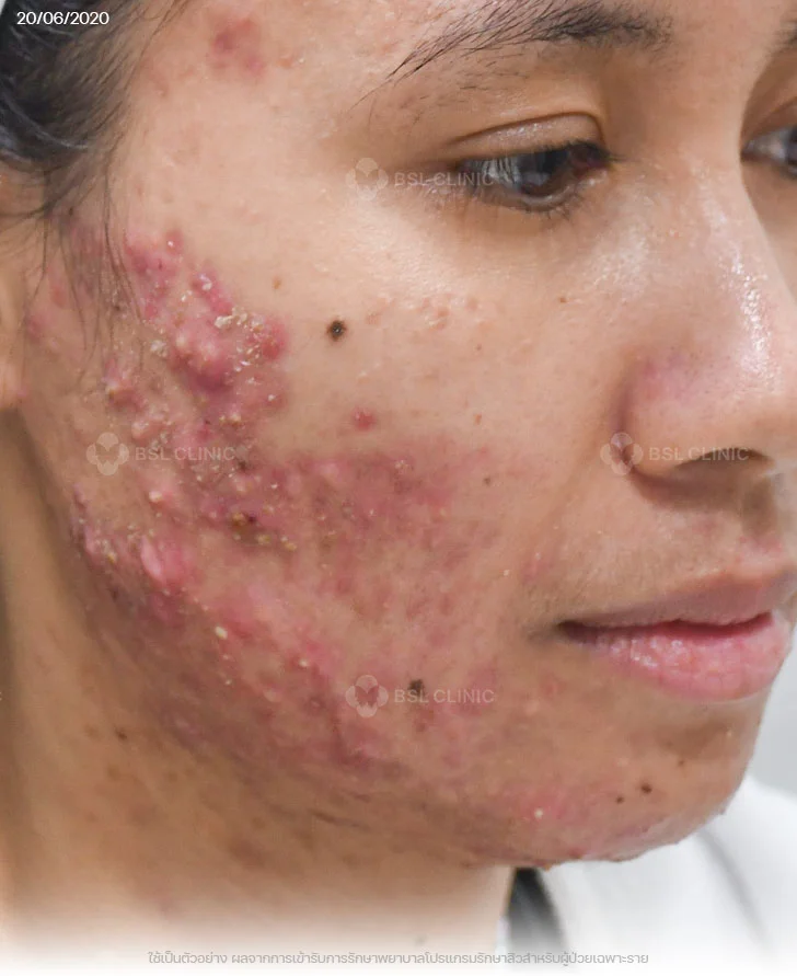 ผลการรักษาสิว-สิวอุดตัน-สิวอักเสบ-รอยแดงสิว-Before-ก่อนรักษา