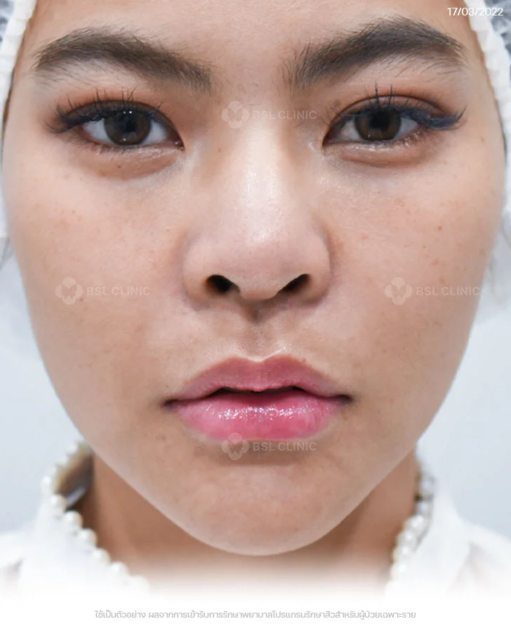 ผลการรักษาสิวฮอร์โมน-สิวที่คาง-สิวอักเสบ-รอยแดงสิว-After-3