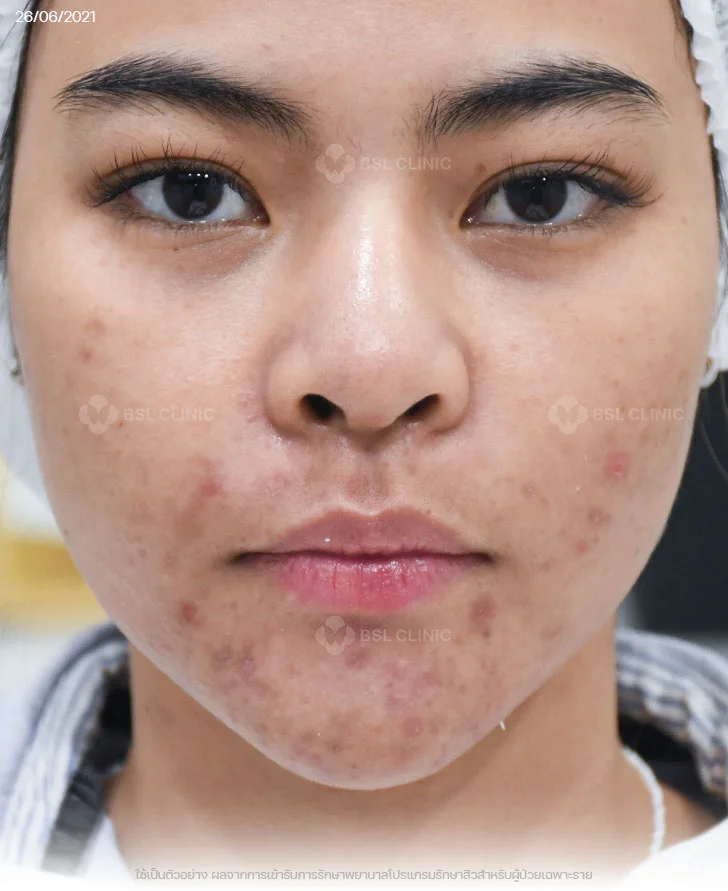 ผลการรักษาสิวฮอร์โมน-สิวที่คาง-สิวอักเสบ-รอยแดงสิว-Before