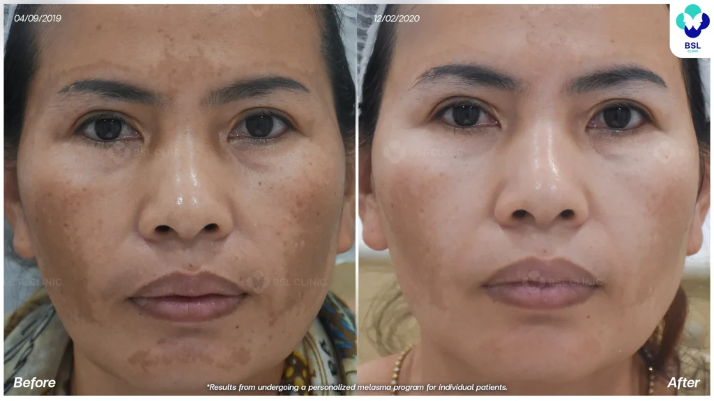 ฝ้า กระ ผลการรักษาฝ้า แดด ฝ้าผสม ฝ้าตื้น ฝ้าลึก