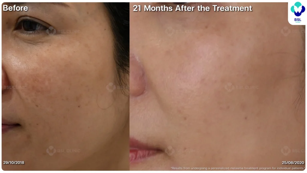 ฝ้า กระ ผลการรักษาฝ้า แดด ฝ้าผสม ฝ้าตื้น ฝ้าลึก