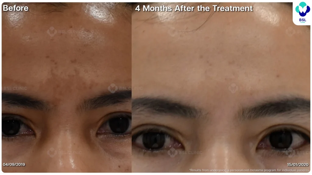 ฝ้า กระ ผลการรักษาฝ้า แดด ฝ้าผสม ฝ้าตื้น ฝ้าลึก