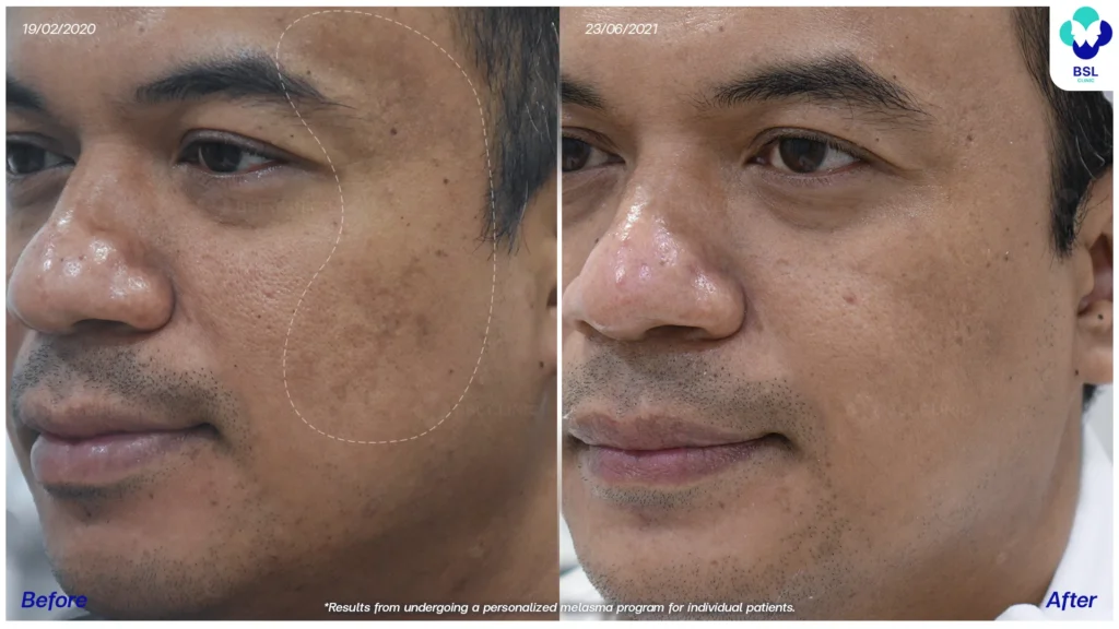 ฝ้า กระ ผลการรักษาฝ้า แดด ฝ้าผสม ฝ้าตื้น ฝ้าลึก