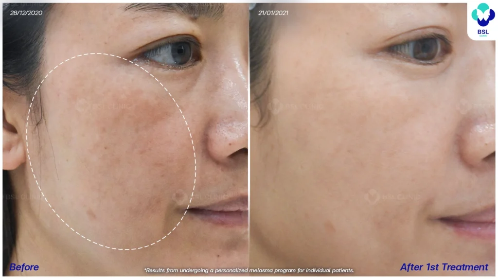 ฝ้า กระ ผลการรักษาฝ้า แดด ฝ้าผสม ฝ้าตื้น ฝ้าลึก