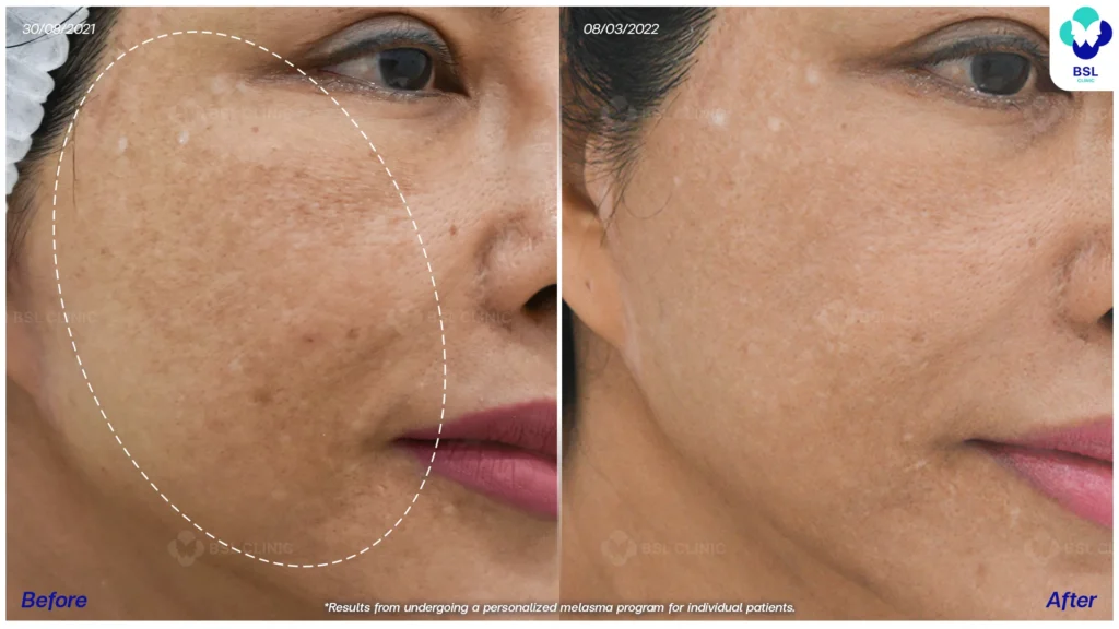 ฝ้า กระ ผลการรักษาฝ้า แดด ฝ้าผสม ฝ้าตื้น ฝ้าลึก