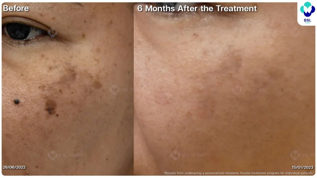 ฝ้า กระ ผลการรักษาฝ้า แดด ฝ้าผสม ฝ้าตื้น ฝ้าลึก