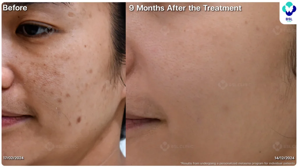 ฝ้า กระ ผลการรักษาฝ้า แดด ฝ้าผสม ฝ้าตื้น ฝ้าลึก