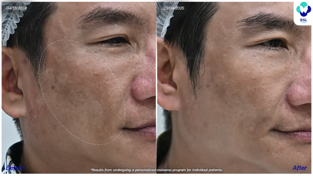 ฝ้า กระ ผลการรักษาฝ้า แดด ฝ้าผสม ฝ้าตื้น ฝ้าลึก