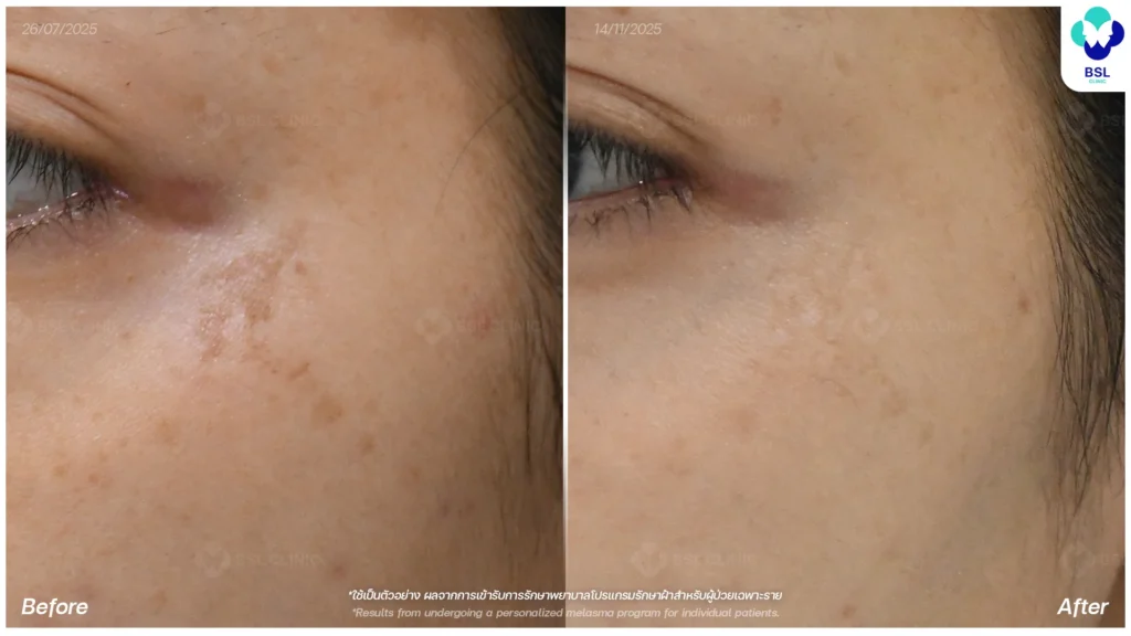 ฝ้า กระ ผลการรักษาฝ้า แดด ฝ้าผสม ฝ้าตื้น ฝ้าลึก