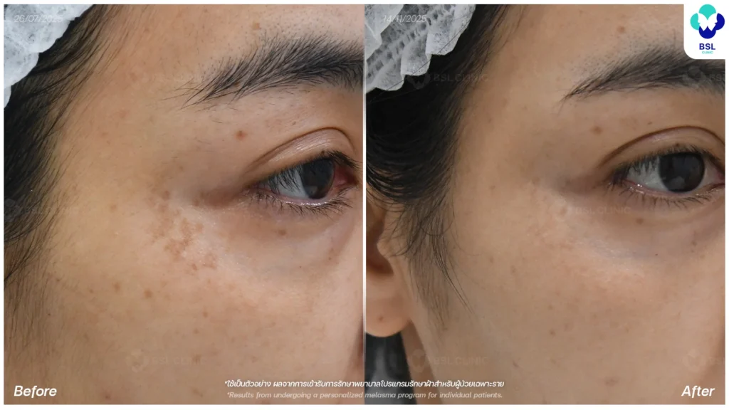 ฝ้า กระ ผลการรักษาฝ้า แดด ฝ้าผสม ฝ้าตื้น ฝ้าลึก