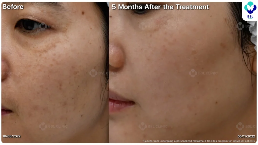 ฝ้า กระ ผลการรักษาฝ้า แดด ฝ้าผสม ฝ้าตื้น ฝ้าลึก