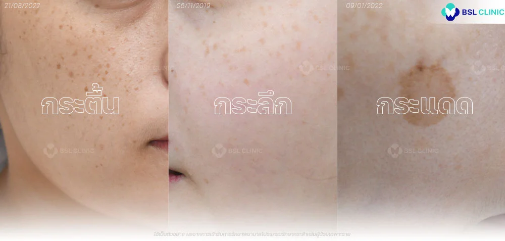 รักษากระ-กระลึก-กระตื้น-กระแดด-BSL-Clinic-2