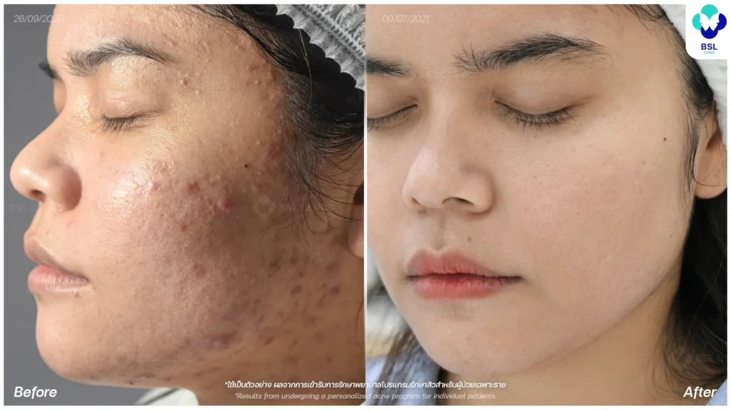 รีวิวรักษาสิว สิวอักเสบ สิวอุดตัน