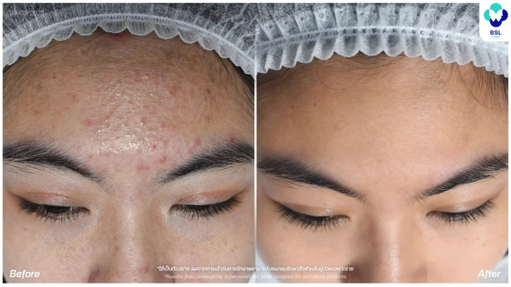 สิว ผลการรักษาสิว สิวอุดตัน