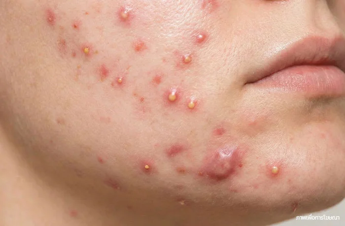 สิวอักเสบ-หัวหนอง-สิวหนอง