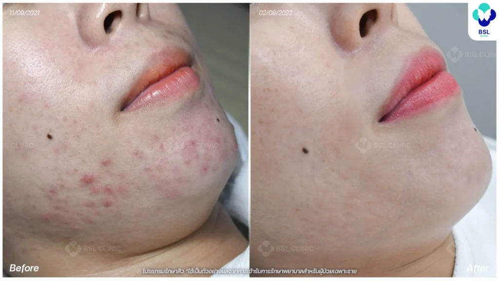 สิวฮอร์โมน