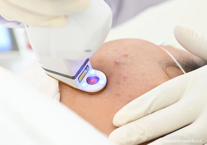 เลเซอร์รักษาสิว-accure-aviclear-bslclinic