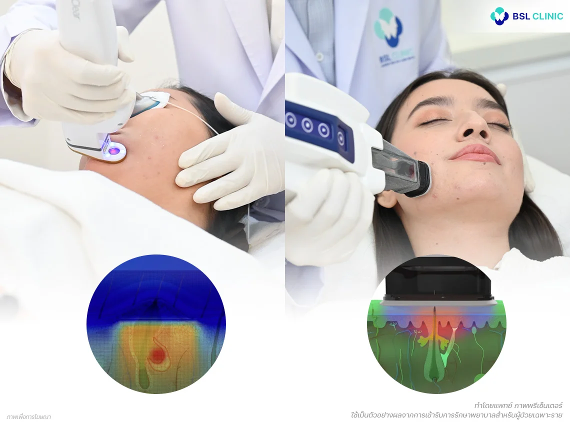 เลเซอร์รักษาสิว-accure-aviclear