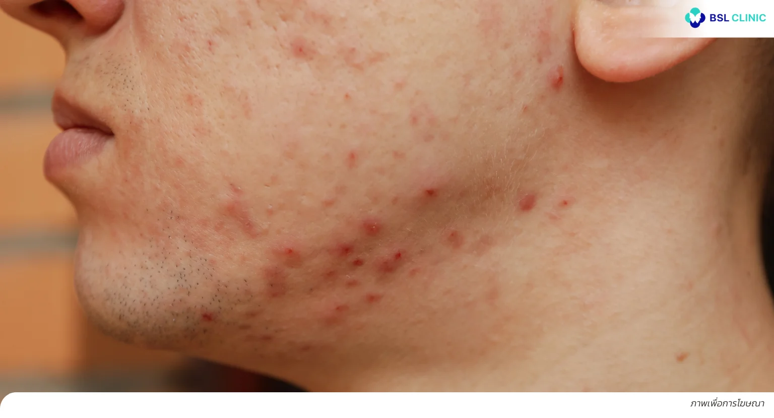 สิวขึ้นกรอบหน้า