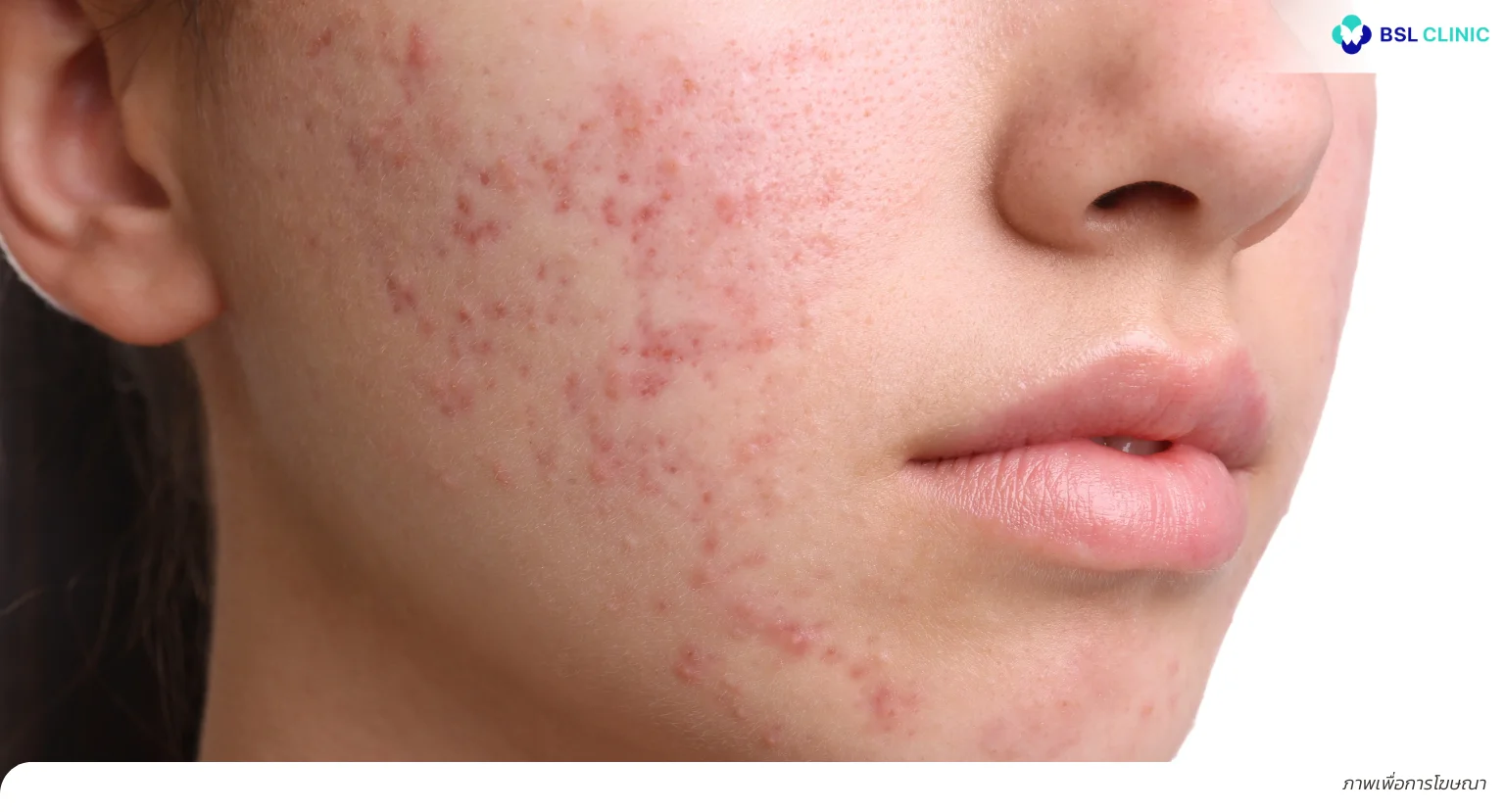 สิวขึ้นกรอบหน้า