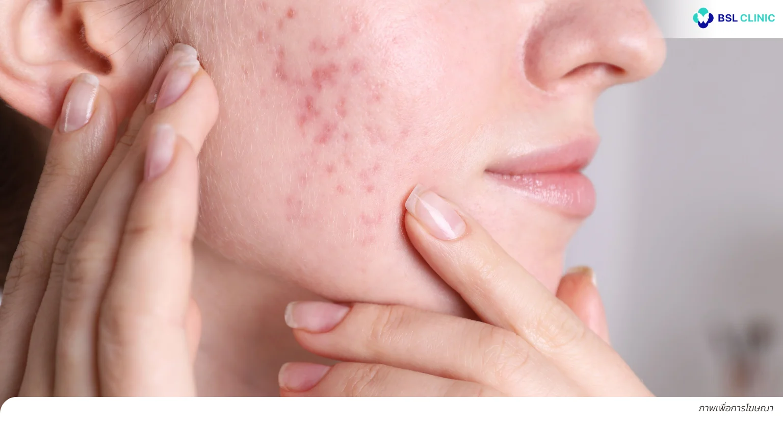 สิวขึ้นกรอบหน้า