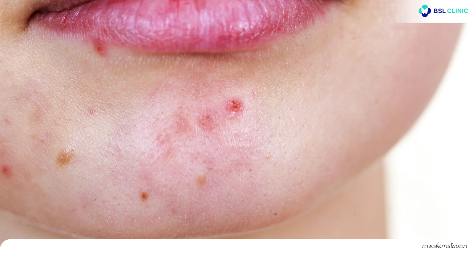 สิวขึ้นคาง