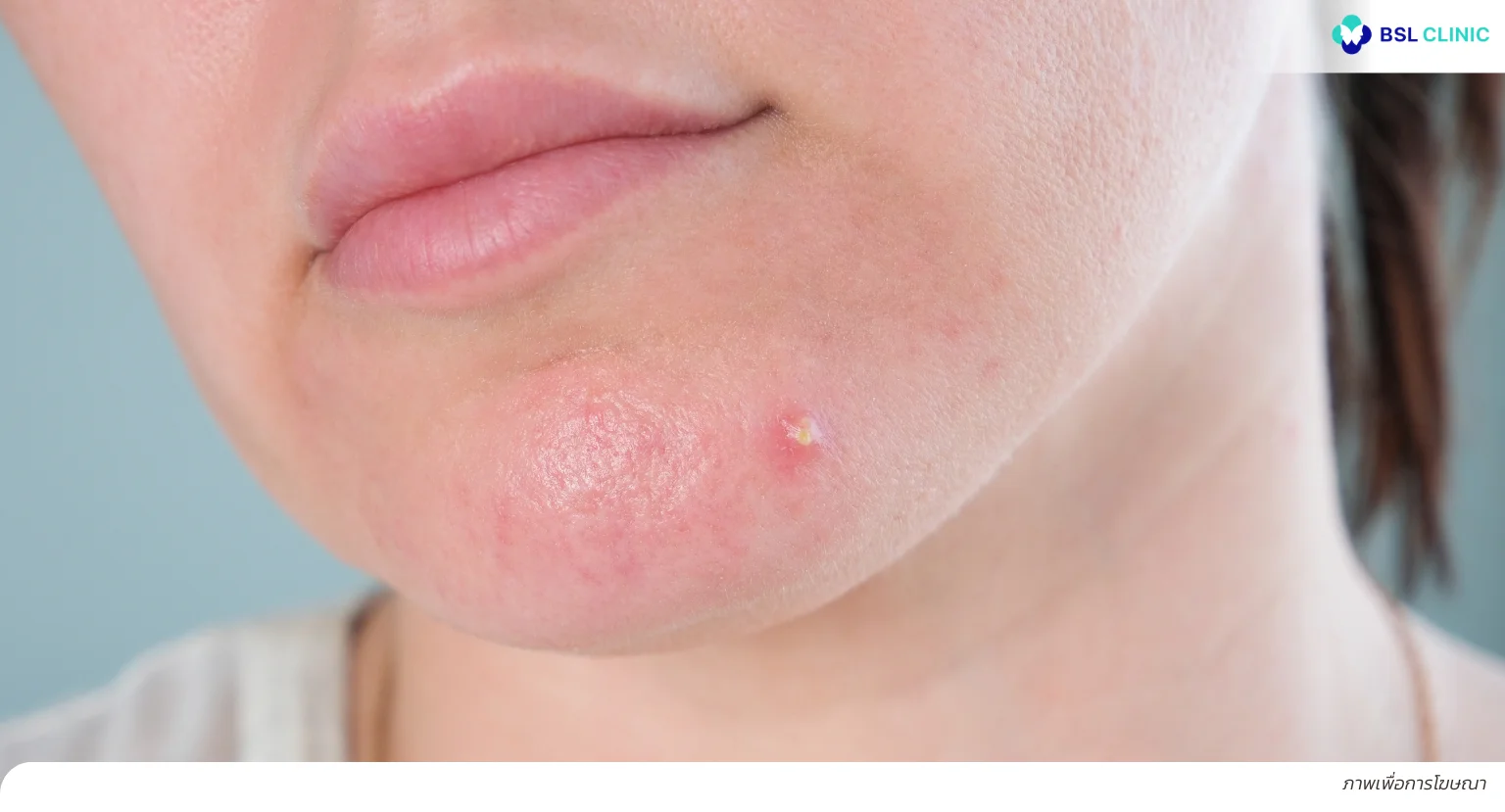 สิวขึ้นคาง