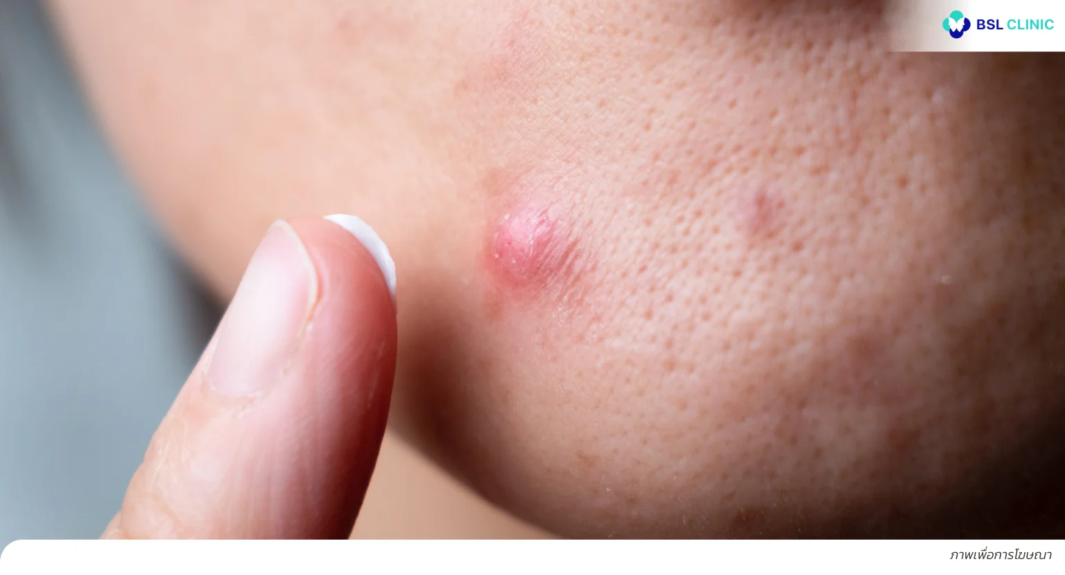 สิวขึ้นคาง