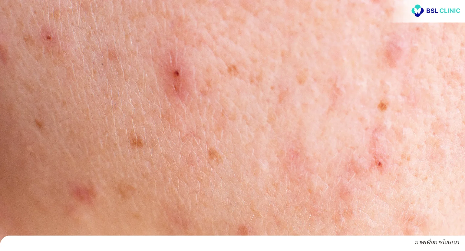 สิวอุดตัน