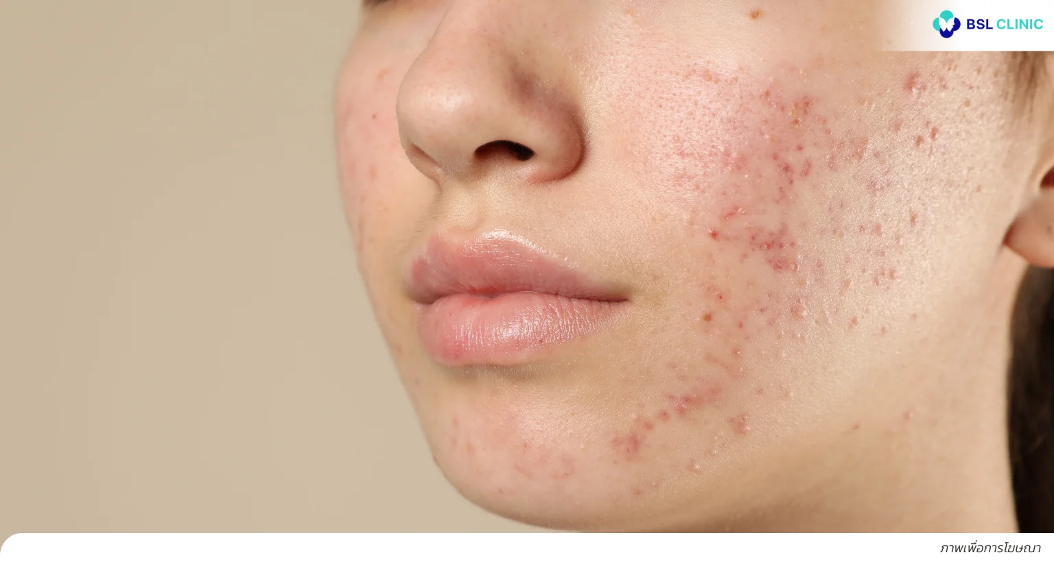 สิวอุดตัน