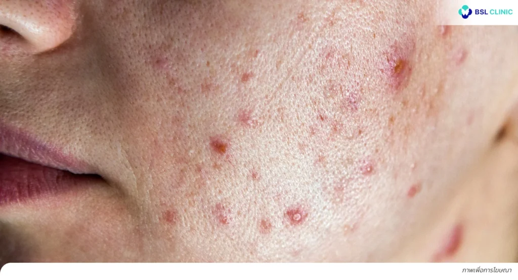 สิวเห่อ