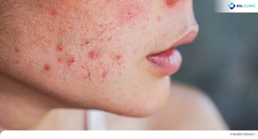 สิวเห่อ