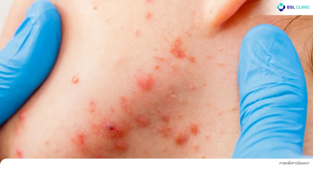 สิวเห่อ