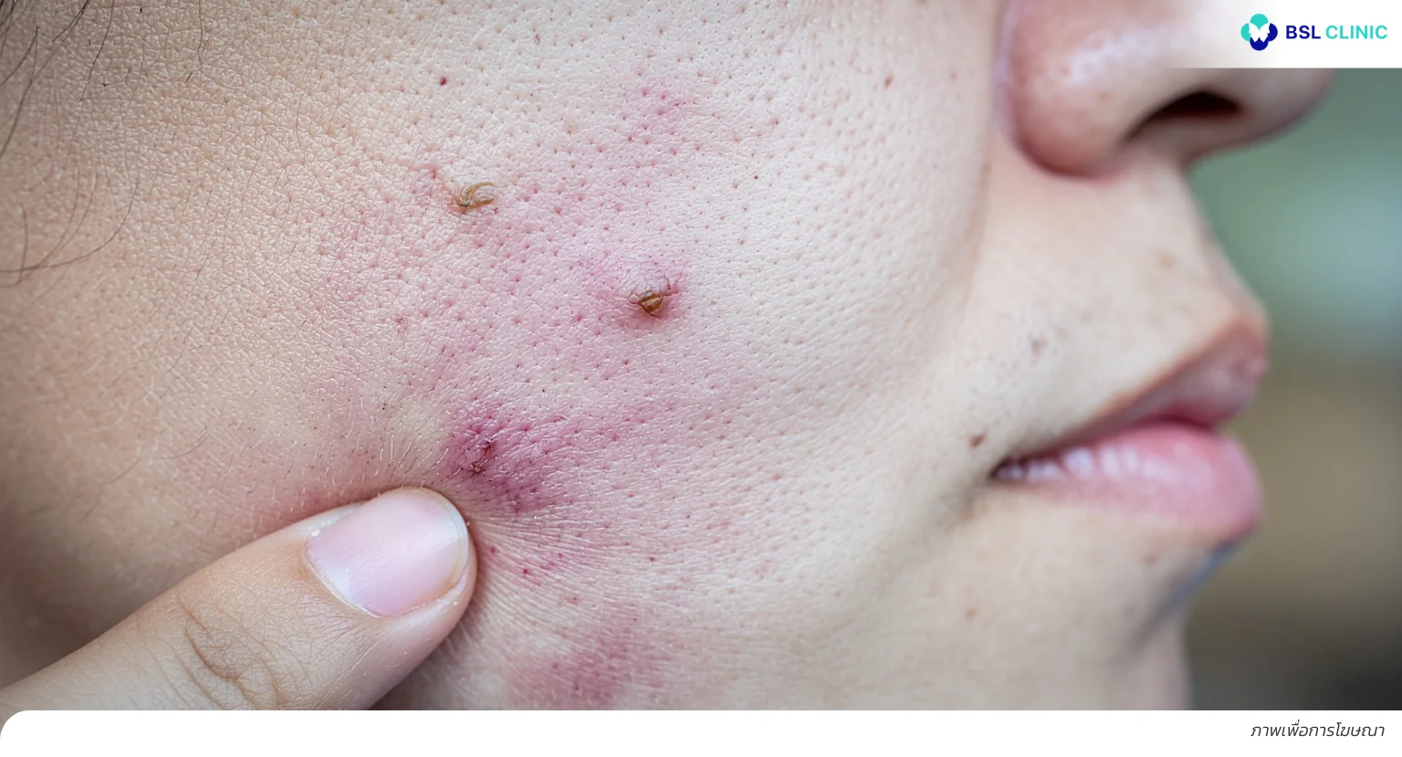 สิวหัวช้าง