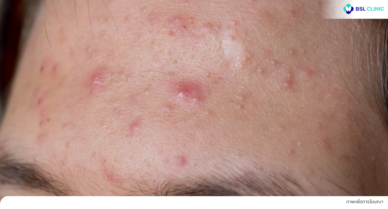 สิวหัวช้าง)