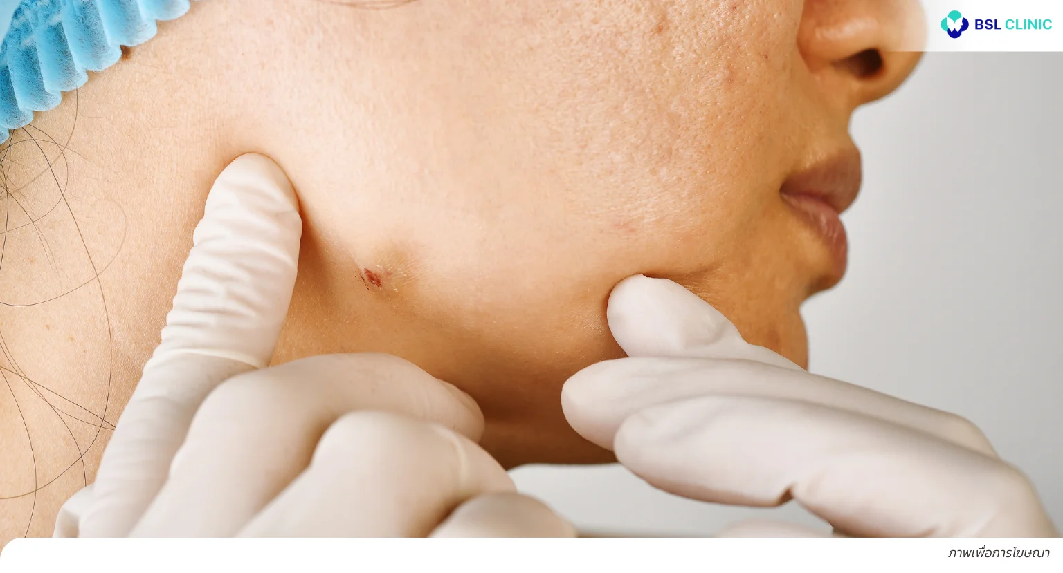 สิวหัวช้าง