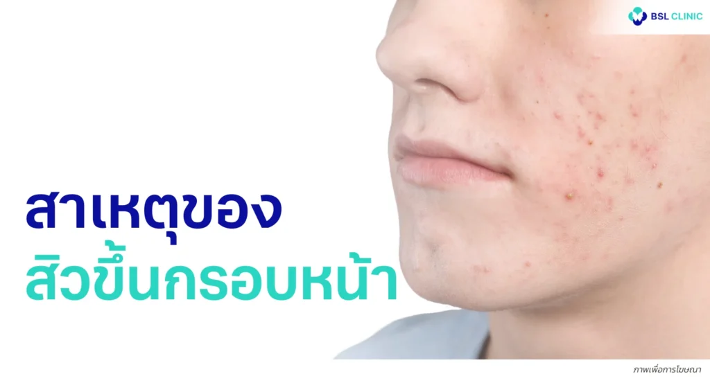 สิวขึ้นกรอบหน้า)