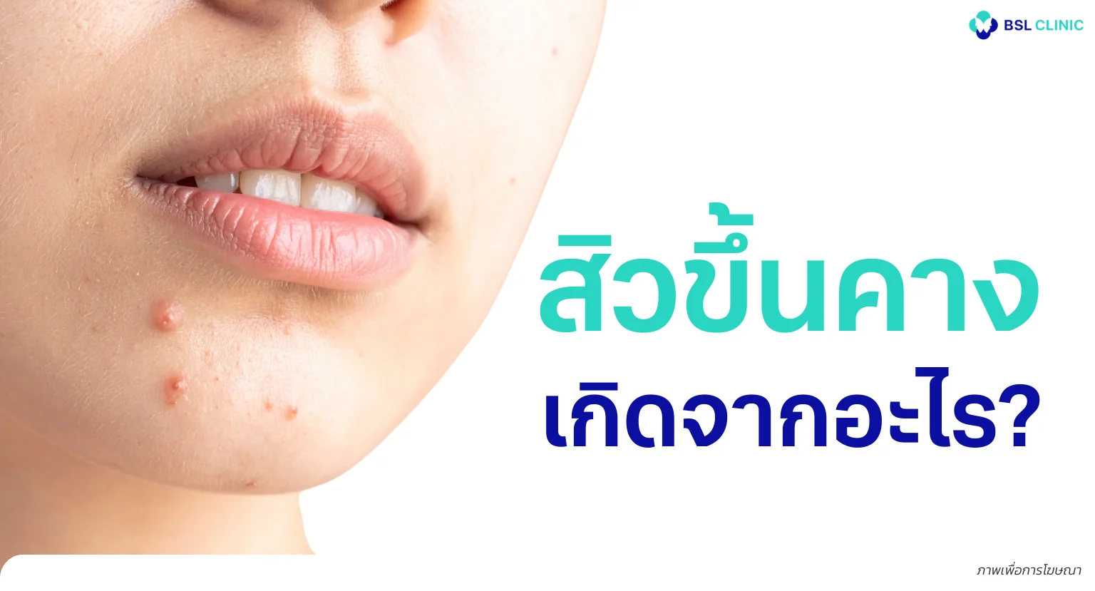 สิวขึ้นคาง