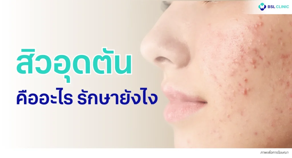 สิวอุดตัน