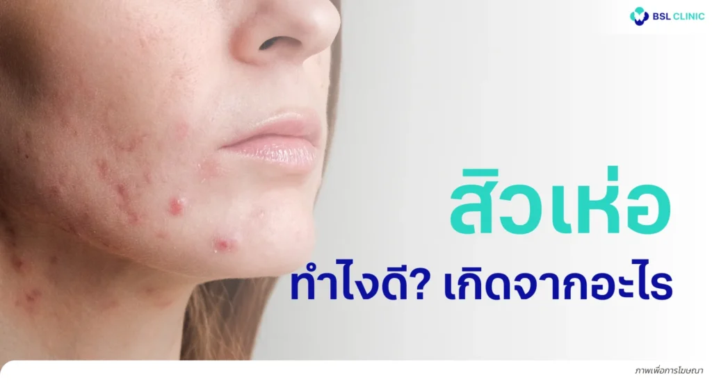 สิวเห่อ