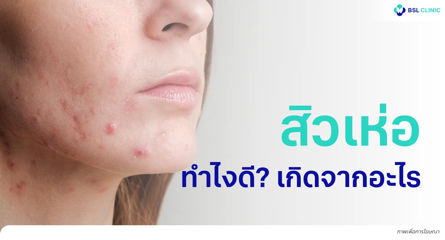 สิวเห่อ