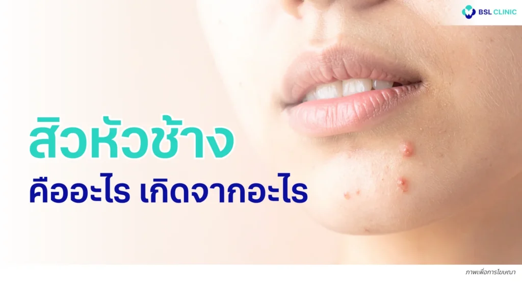 สิวหัวช้าง