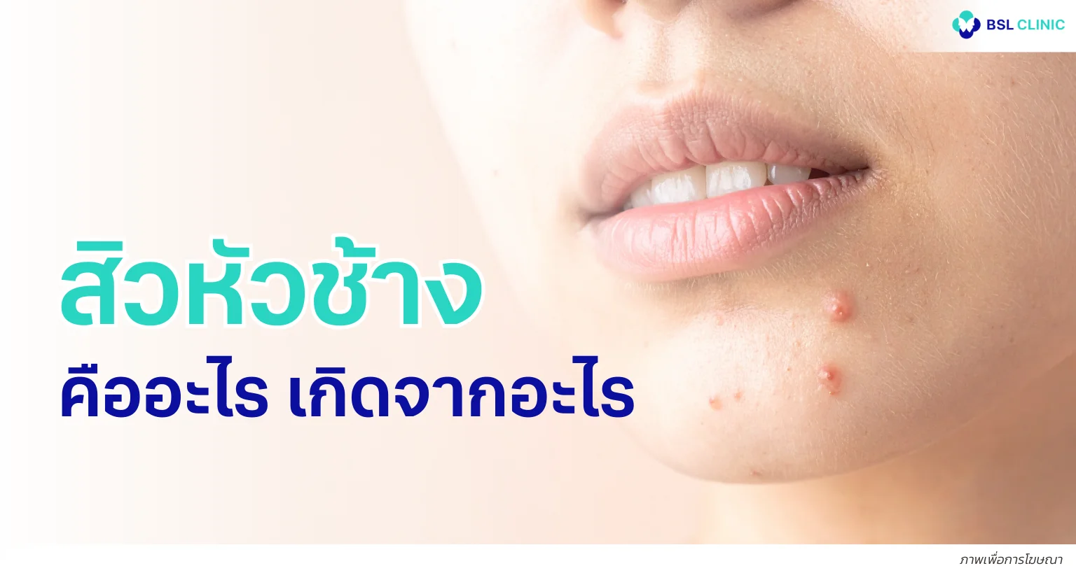 สิวหัวช้าง