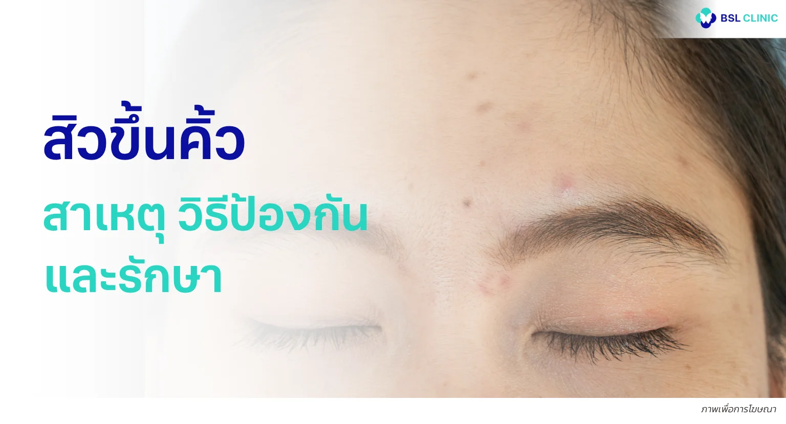 สิวขึ้นคิ้ว สิวขึ้นระหว่างคิ้ว)