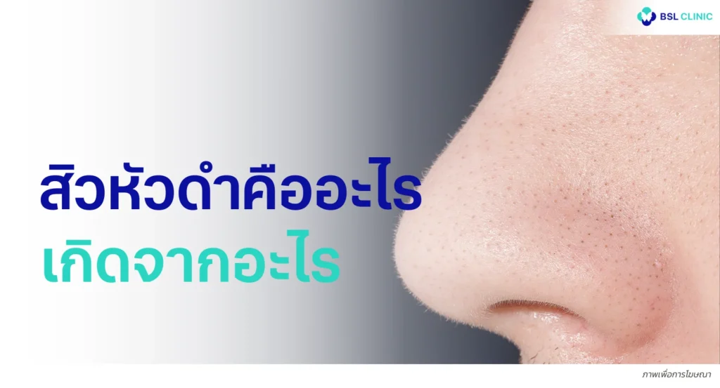 สิวหัวดำ